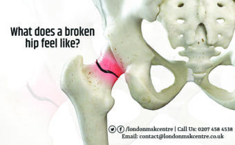 What does a broken hip feel like? LondonMSKCentre.co.uk